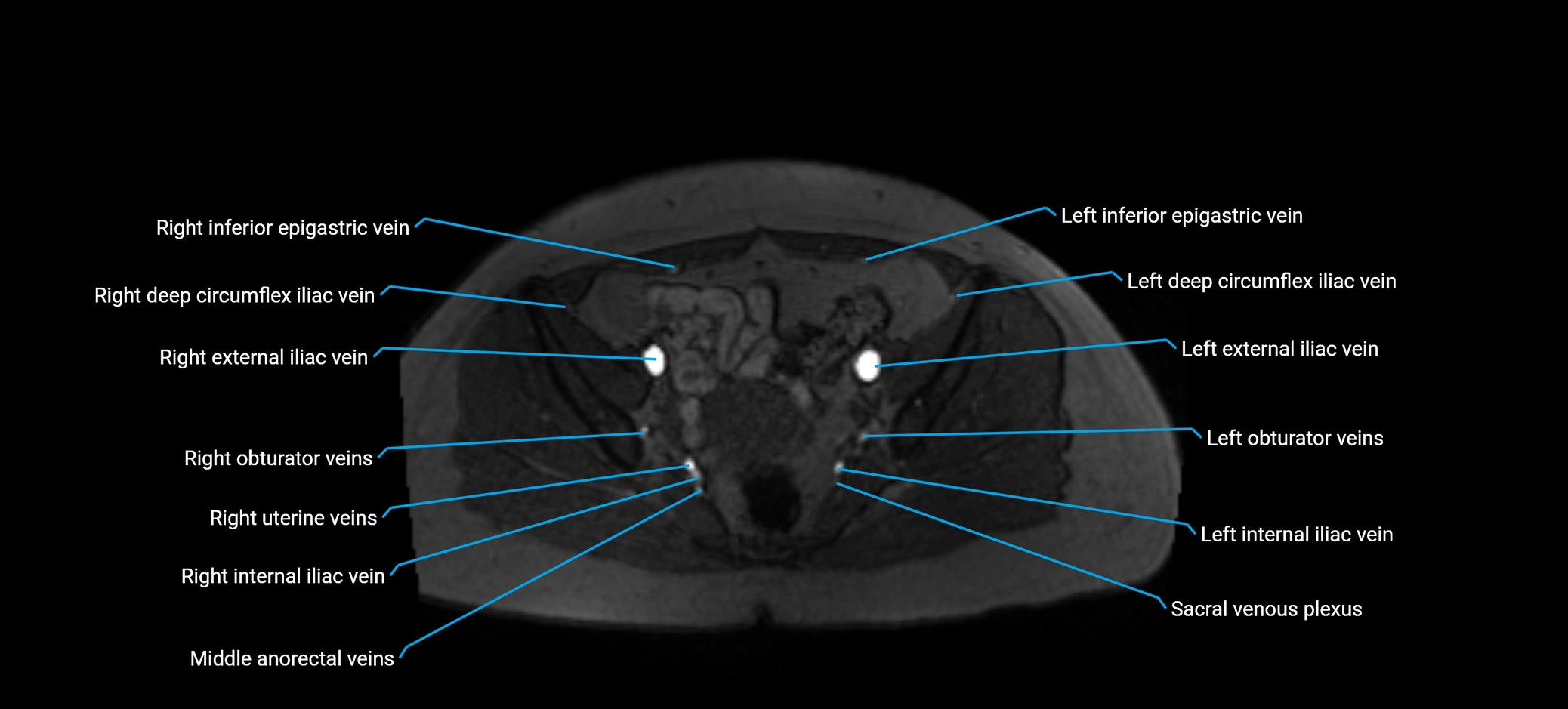 MRV abdomen pelvis & lower limb axial cross sectional anatomy labelled MRI image 155 (1).webp